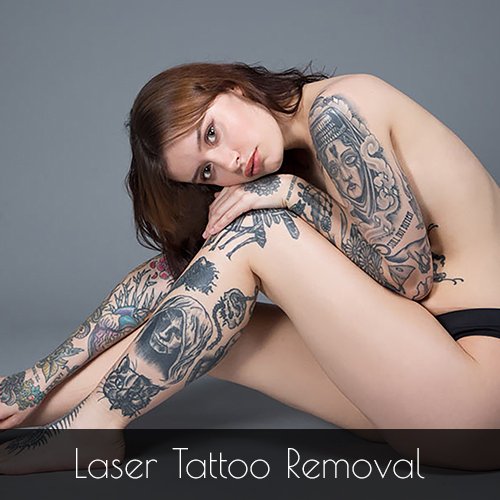 laser tattoo Removal London - on