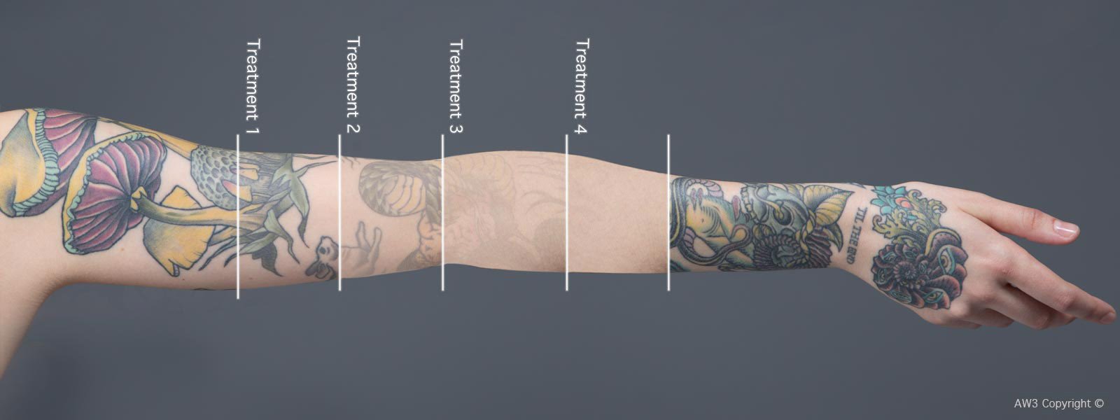 tattoo removal process london
